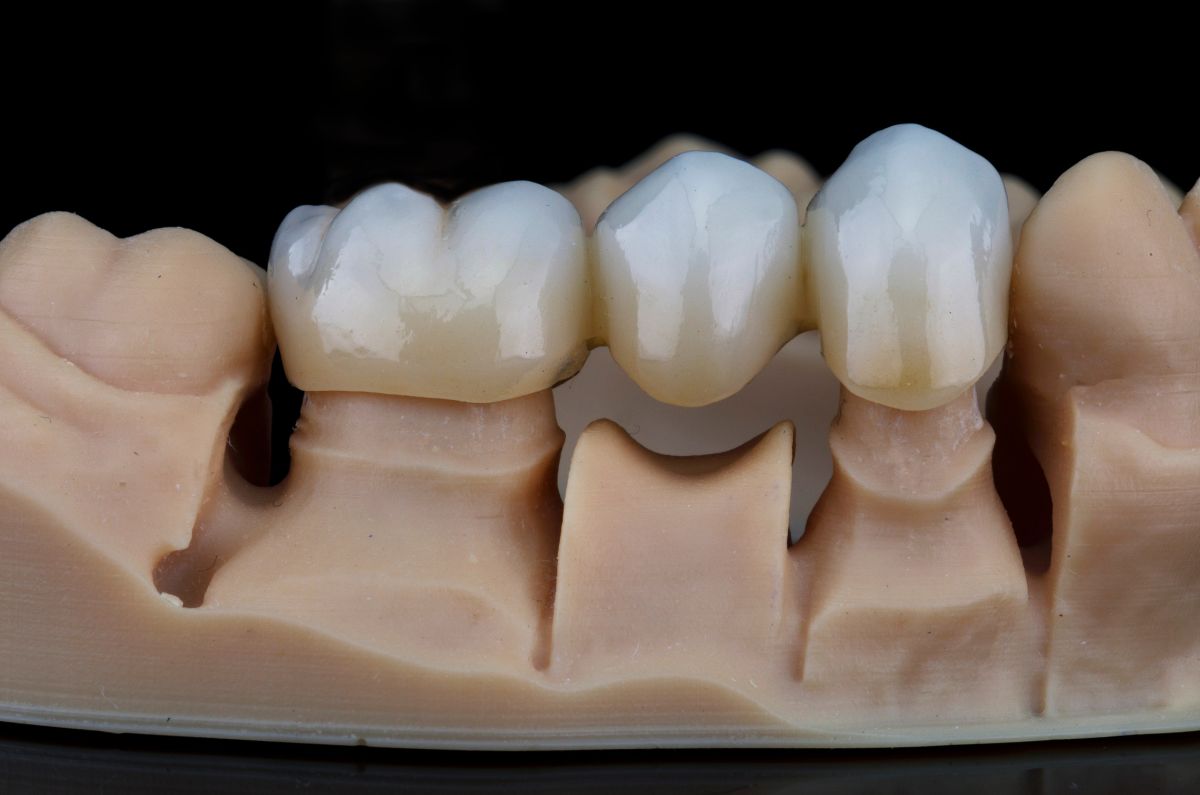 Dental Crowns & Fillings